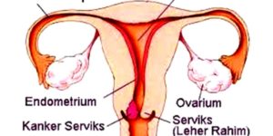 Pap Smear Kanker Serviks, BPJS Kesehatan Lakukan Deteksi Dini