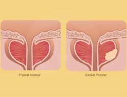 Kanker Prostat untuk pria 50 tahun ke atas